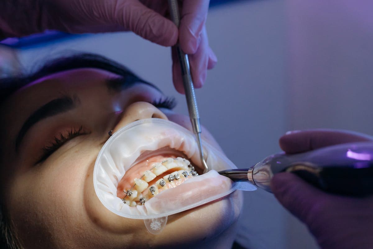 Braces and Orthodontics Aftercare: The Complete Guide to a Successful Treatment